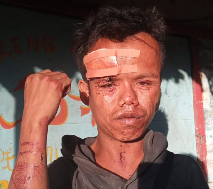 Seorang Disabilitas, Dikeroyok 2 Orang Tak Dikenal luka luka di Wajah